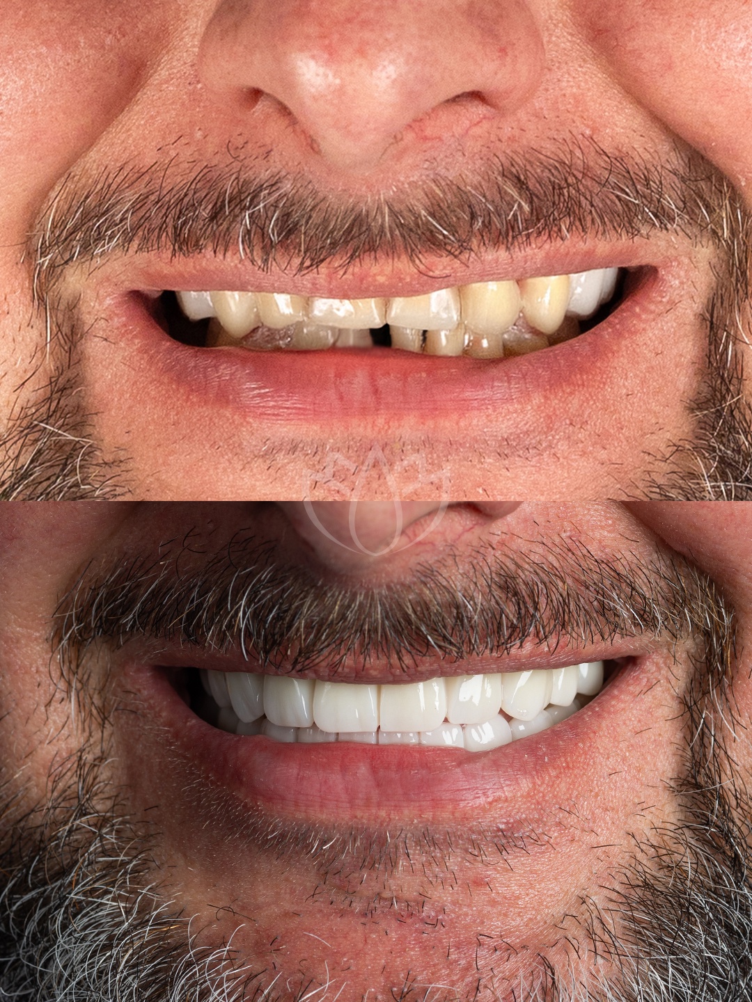 Resultado, Reabilitação com coroas