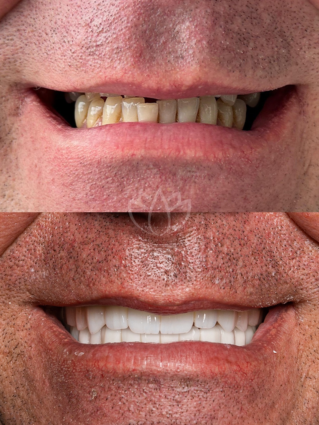 Resultado, Hollywood Smile